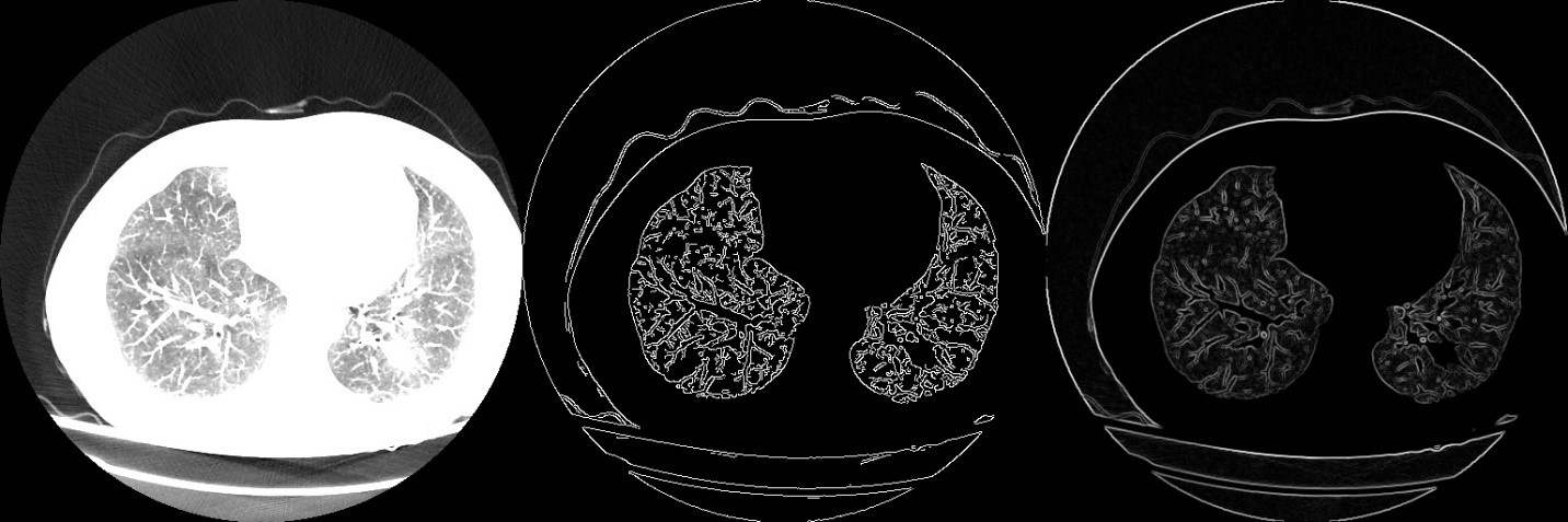 Medical Image Processing, Image Processing, Medical Imaging, Precision, python code, medical diagnostic, Acute Myeloid Leukemia (AML), Leukemia, Cancer Imaging, Cancer diagnostic